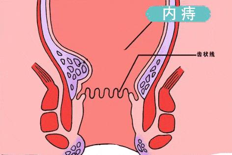 醫(yī)用痔瘡凝膠廠家